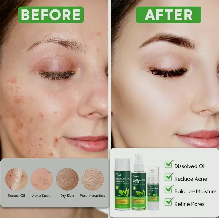Acne Care Kit with Wash, Refresher, Moisturizer